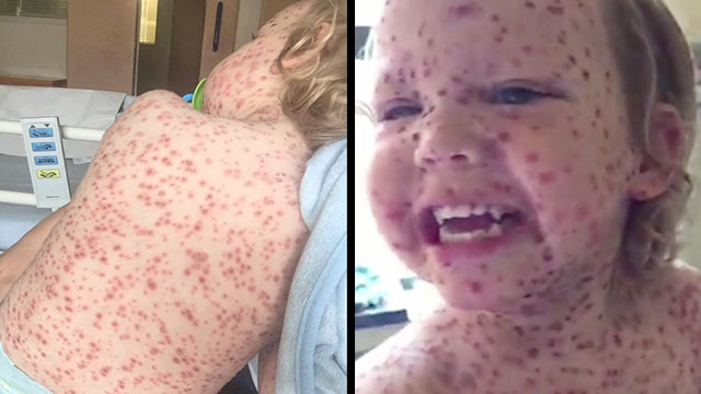 Chickenpox Diagnosis Shocks Doctors But Little Jasper Is 